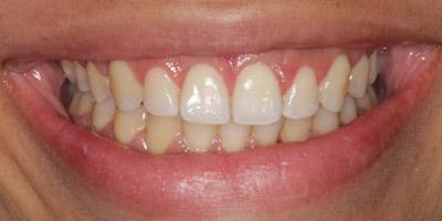 After Gingival Recontouring
