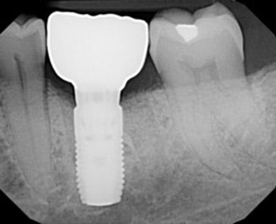After Immediate Dental Implants to Replace Back Teeth