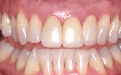 After Immediate Dental Implants in the Cosmetic Zone