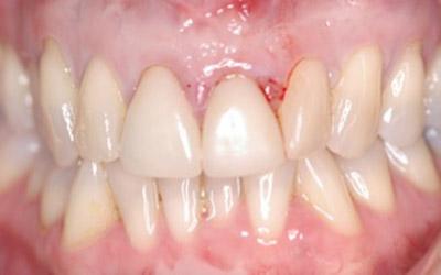 Before Immediate Dental Implants in the Cosmetic Zone