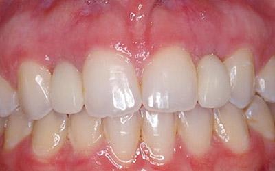 After Immediate Dental Implant Provisionalization