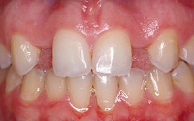 Before Immediate Dental Implant Provisionalization