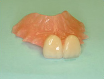 Flipper or Partial Denture
