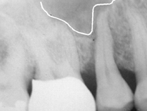 Pre-Op x-rays Reveal Void of Bone Above Tooth to be Extracted
