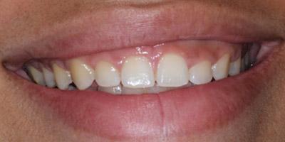 Before Results for Gingival Recontouring