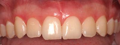 After Results for Gingival Recontouring