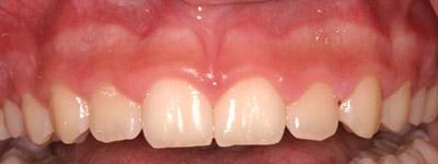 Before Results for Gingival Recontouring