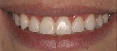 After Results for Gingival Recontouring