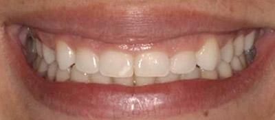 Before Results for Gingival Recontouring