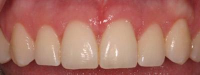 After Results for Gingival Recontouring