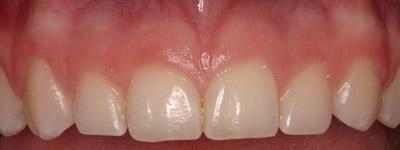 Before Results for Gingival Recontouring