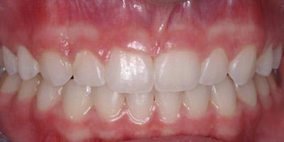 Before Results for Gingival Recontouring