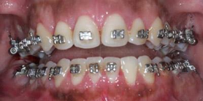 After Results for Gingival Recontouring