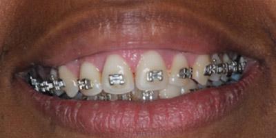 After Results for Gingival Recontouring