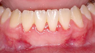 After Results for Epithelialized Soft Tissue Grafts