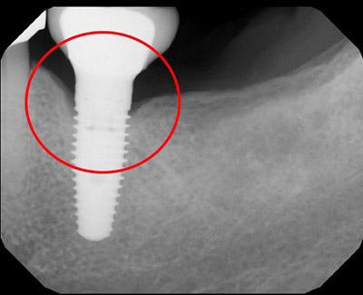 After Results for Laser Treatment