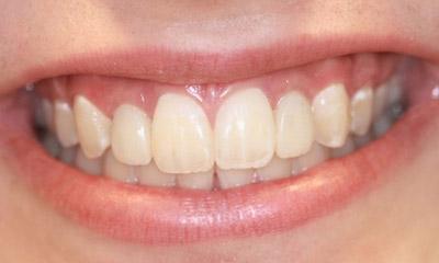 St. Charles Dental Before and After Photos - Illinois Periodontics