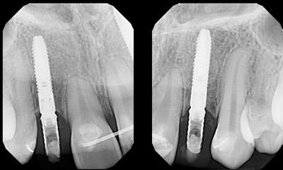 After Results for Rebuilding Lost Tissue Using Grafting