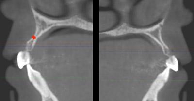 Before Results for Rebuilding Lost Tissue Using Grafting