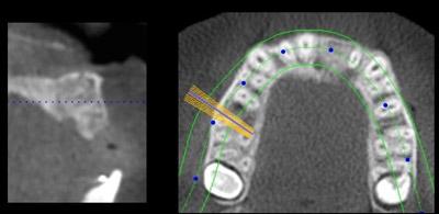 After Results for Rebuilding Lost Tissue Using Grafting