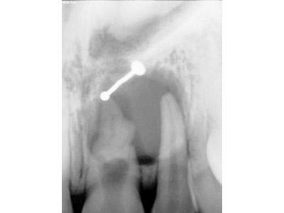 Before Results for Rebuilding Lost Tissue Using Grafting