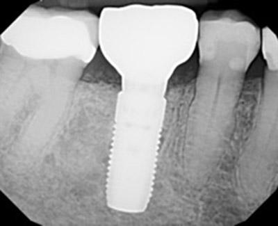 After Results for Immediate Dental Implants to Replace Back Teeth