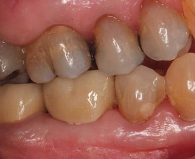 After Results for Immediate Dental Implants to Replace Back Teeth