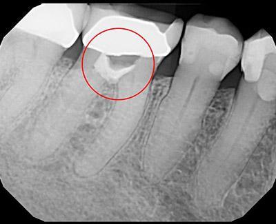 Before Results for Immediate Dental Implants to Replace Back Teeth