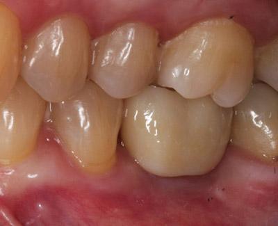 After Results for Immediate Dental Implants to Replace Back Teeth