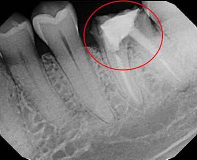 Before Immediate Dental Implants to Replace Back Teeth