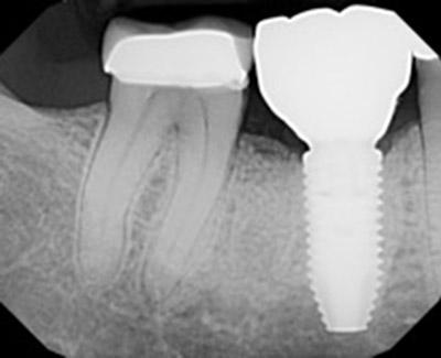 After Results for Immediate Dental Implants to Replace Back Teeth