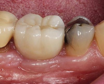 After Results for Immediate Dental Implants to Replace Back Teeth