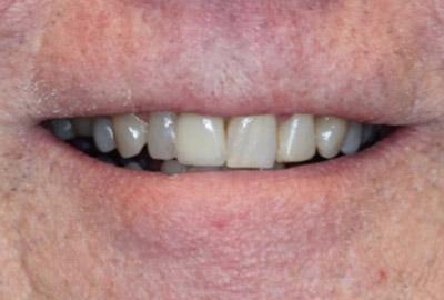 After Results for Immediate Dental Implants in the Cosmetic Zone