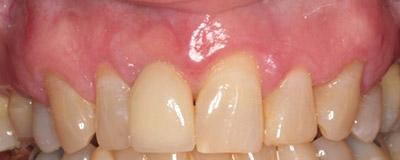 After Results for Immediate Dental Implants in the Cosmetic Zone