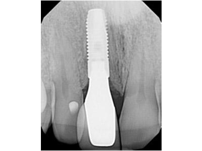 After Results for Immediate Dental Implants in the Cosmetic Zone