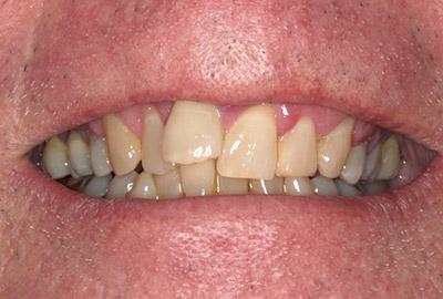 Before Results for Immediate Dental Implants in the Cosmetic Zone