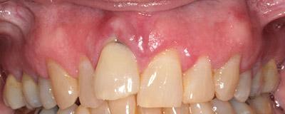 Before Results for Immediate Dental Implants in the Cosmetic Zone