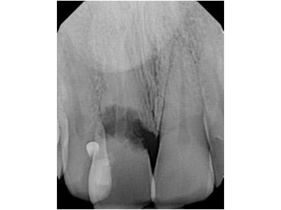 Before Results for Immediate Dental Implants in the Cosmetic Zone