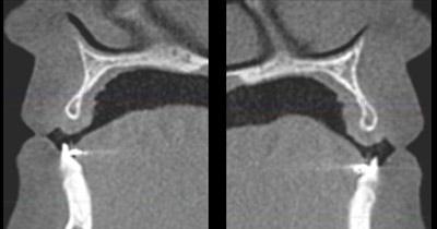 After Results for Rebuilding Lost Tissue Using Grafting