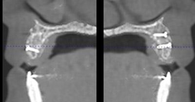 After Results for Rebuilding Lost Tissue Using Grafting