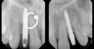 After Results for Rebuilding Lost Tissue Using Grafting