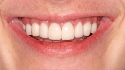 After Results for Rebuilding Your Smile with Collaborative Care