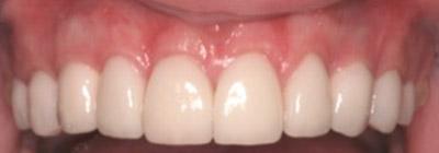 After Results for Rebuilding Your Smile with Collaborative Care