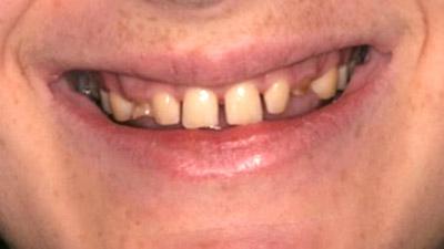 Before Results for Rebuilding Your Smile with Collaborative Care