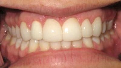 After Results for Rebuilding Your Smile with Collaborative Care