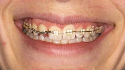 Before Results for Rebuilding Your Smile with Collaborative Care