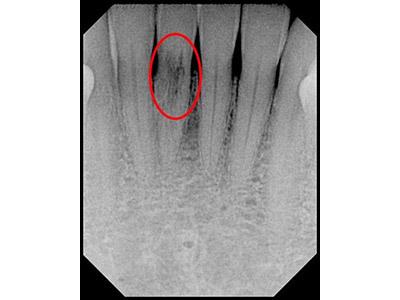 Before Results for Immediate Dental Implants in the Cosmetic Zone