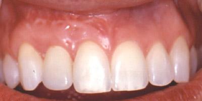 After Results for Immediate Dental Implants in the Cosmetic Zone