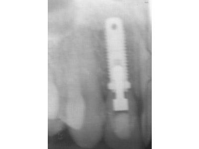 After Results for Immediate Dental Implants in the Cosmetic Zone