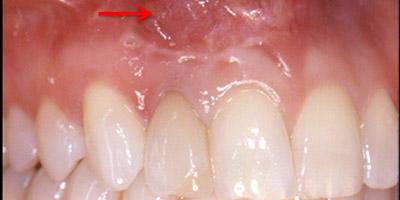 Before Results for Immediate Dental Implants in the Cosmetic Zone